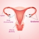 Endometriozis Nedir? - Prof. Dr. Engin Oral