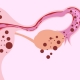 Endometriozis Nedir? - Prof. Dr. Engin Oral