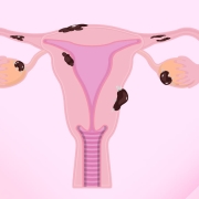 Endometriozis Teşhisi - Prof. Dr. Engin Oral