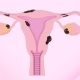Endometriozis Teşhisi - Prof. Dr. Engin Oral